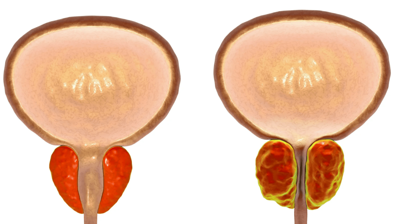 Τι είναι η προστατίτιδα