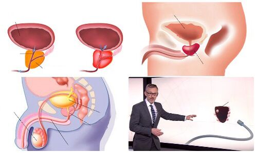 υγιή και άρρωστο προστάτη